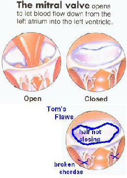 faulty mitral valve